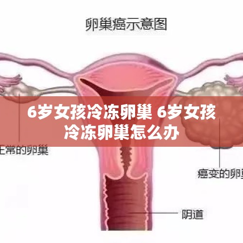 6岁女孩冷冻卵巢 6岁女孩冷冻卵巢怎么办