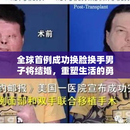 全球首例成功换脸换手男子将结婚，重塑生活的勇气与爱情的力量